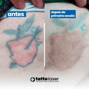 Remoção de tatuagem, antes e depois. 