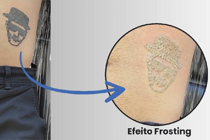 Frosting. Reação pós laser