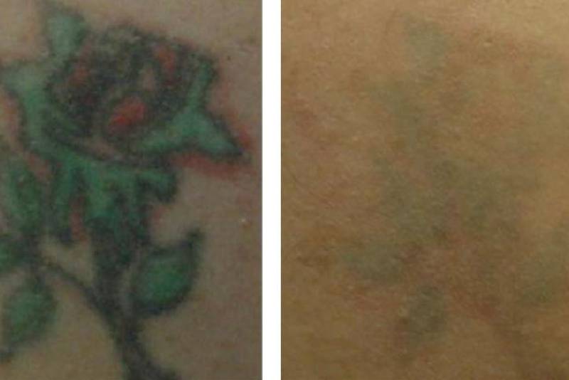 remoção tatuagem colorida
