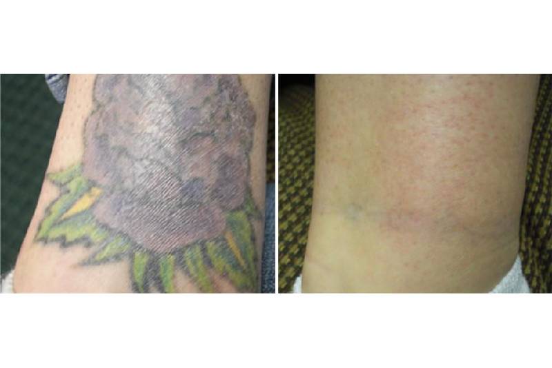 remoção tatuagem colorida