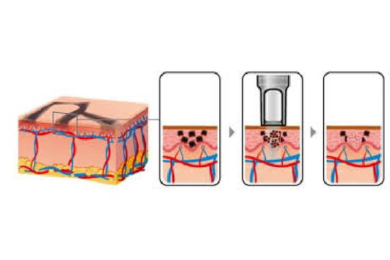 Processo de remoção de tatuagem a laser na Tattoo Laser