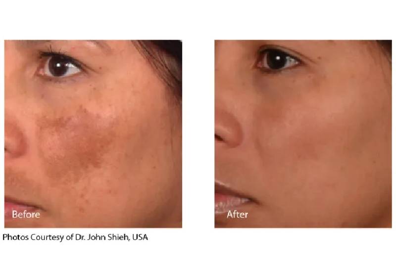 Tratamento de Melasma e Hiperpigmentação