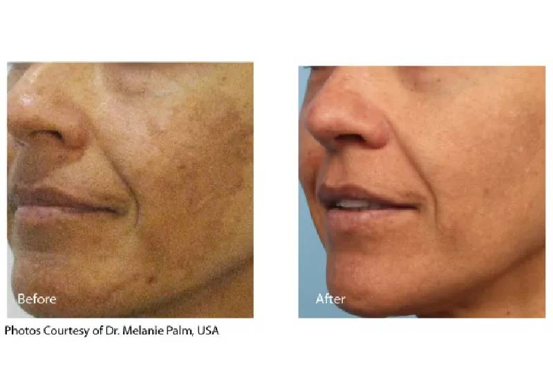 Tratamento de Melasma e Hiperpigmentação