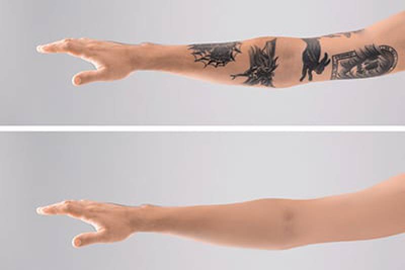 Remoção de tatuagem deixa cicatriz