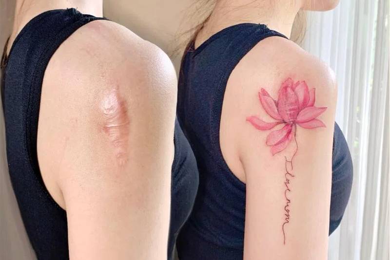 Remoção de Tatuagem em Cicatrizes