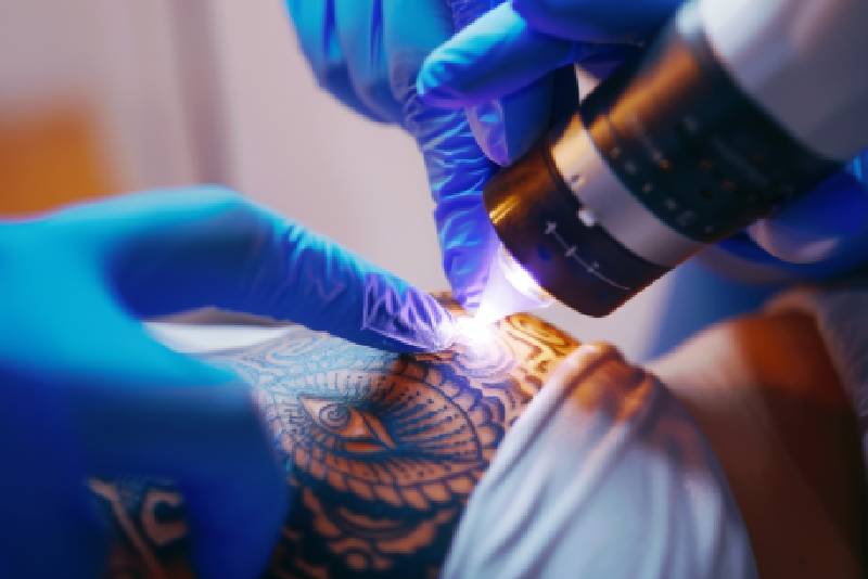 As diferenças entre lasers portáteis e os lasers avançados da Tattoo Laser: por que a tecnologia faz toda a diferença
