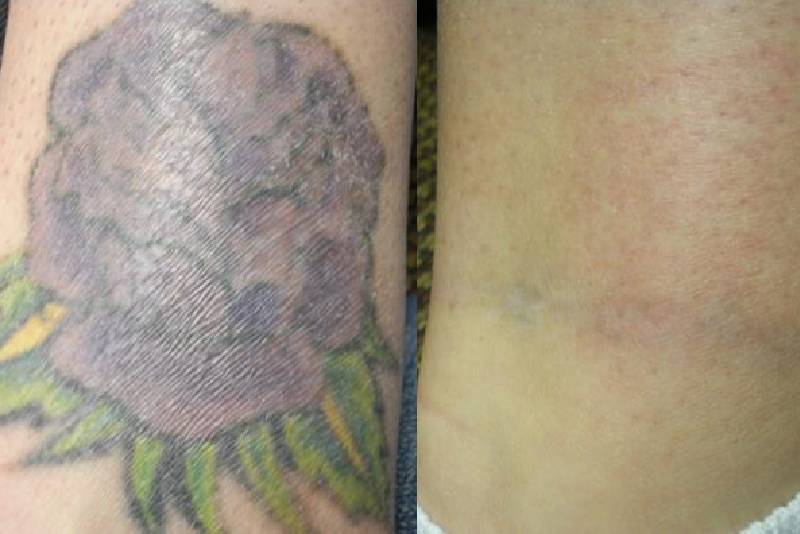 remoção tatuagem colorida