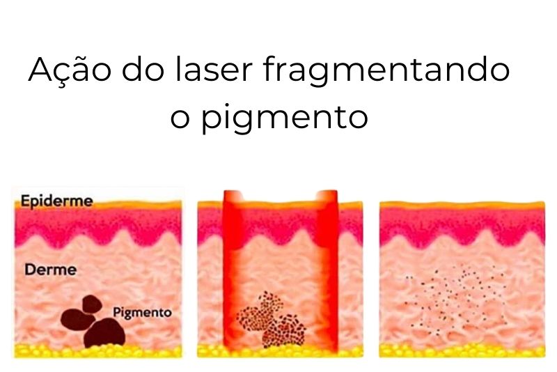 Remoção de tatuagem. Ação do laser no pigmento