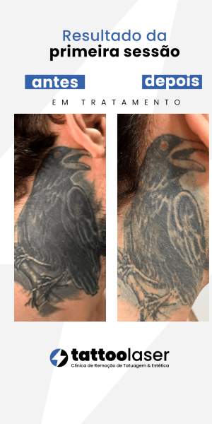 Remoção de tatuagem resultados tattoo laser
