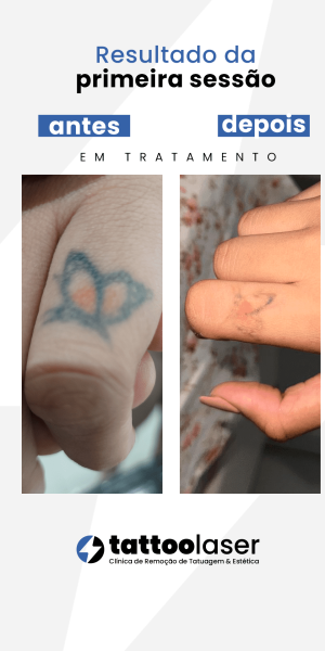Remoção de tatuagem resultados tattoo laser